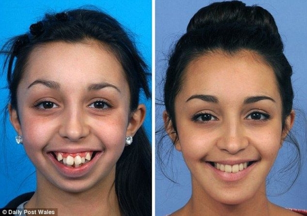 戴牙套后脸型变化图图片